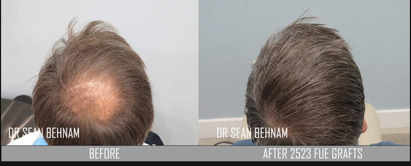 Hair Transplant Los Angeles Dr. Sean Behnam clinic